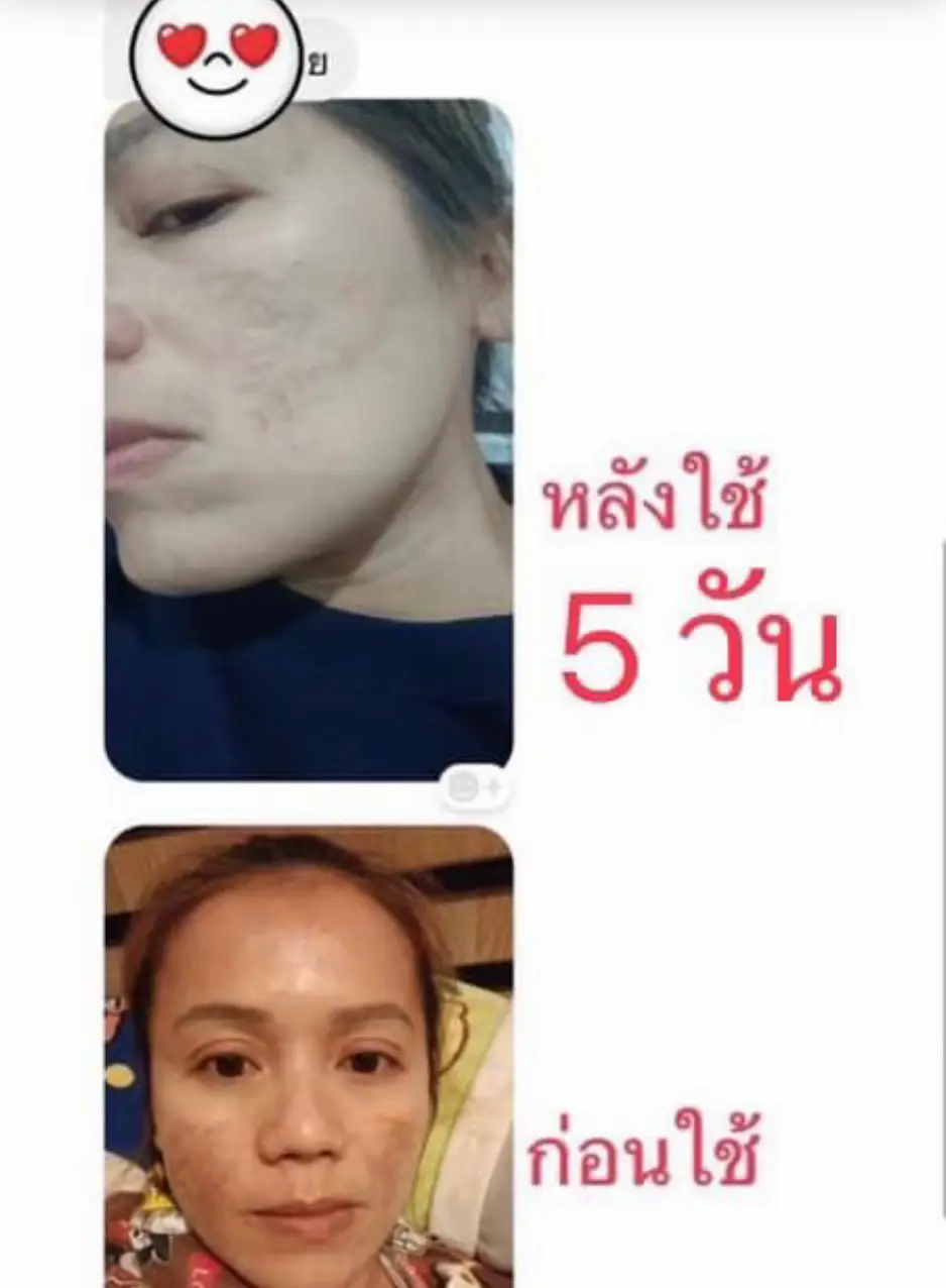 #แชร์วิธีฝ้าจาง #แชร์วิธีสิวหาย #สกินแคร์ไร้สารเคมีสําหรับคนแพ้ง่าย #ครีมฝ้า #ฝ้าจางสิวหาย 