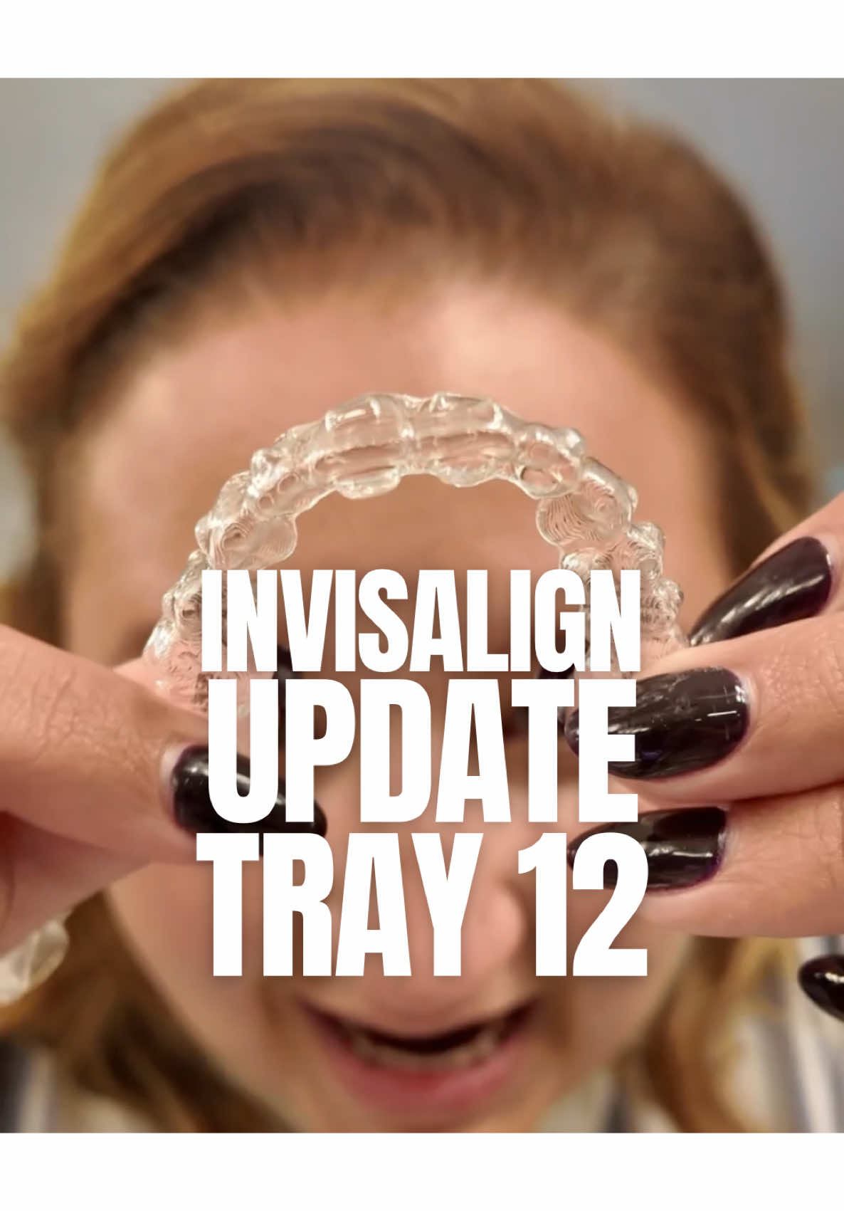 I’m really starting to see changes and visiting the dentist solidified that my teeth are getting straighter … over halfway there!!! #Invisalign #invisalignjourney #smileupdate #tray12
