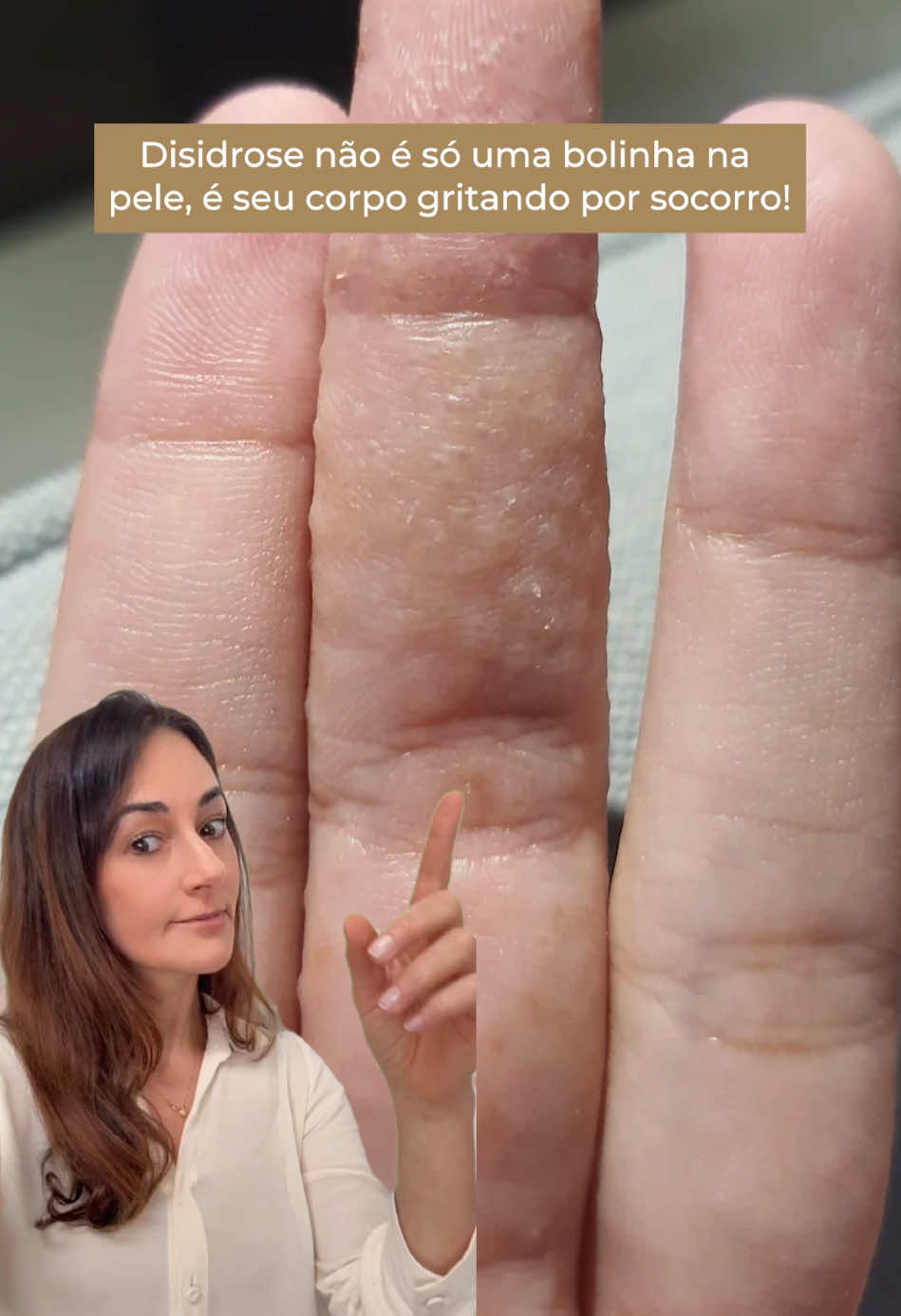 Você sabia que aquelas bolhas nas mãos ou nos pés podem ser mais do que um simples incômodo? A disidrose é uma condição inflamatória da pele que se manifesta com pequenas vesículas cheias de líquido, geralmente acompanhadas de coceira intensa, ardor e vermelhidão. Em casos mais avançados, pode causar descamação e rachaduras dolorosas. As crises podem durar dias ou até semanas e são desencadeadas por estresse, alergias, mudanças bruscas de temperatura, suor excessivo ou contato com produtos químicos. Embora não tenha cura definitiva, é possível controlar os sintomas fortalecendo a barreira cutânea, protegendo contra agentes irritantes e evitando a perda excessiva de água. 👉🏻 Aposte em géis de limpeza suaves e cremes reparadores para proteger e restaurar a pele durante as crises. Você conhece alguém que sofre com disidrose? #disidrose #eczema #dermatite #peleirritada #coceira      