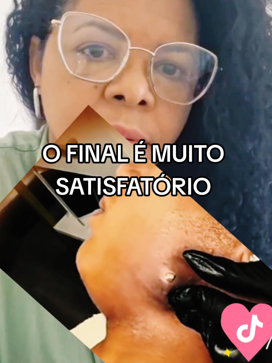 Retirando espinha gigante😱#cravoseespinhas #espinhas  #curiosidades #cravos  #creatorsearchinsights 
