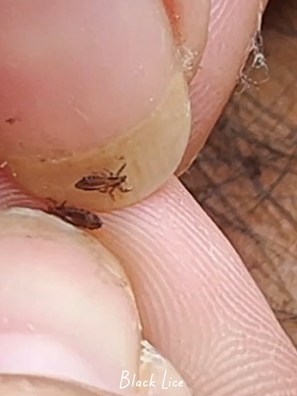 Lice Removal 381 #omg #lice #tripofobia #liceremoval #licetreatment 