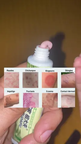 Kung may mga kati-kati ka dyan sa katawan mo na di parin gumagaling bakit di mo to etry. #zudaifu #zudaifuantibacterialcream #skinproblem #skinallergy 