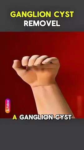 Ganglion Cyst Removal Surgery (3D Animation) #ganglioncyst #ganglioncystcheck #ganglioncystsurgery #ganglioncystremoval #ganglion 