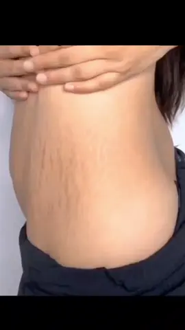 #stretchmarkremoval #beautyroom #whatsapp9742873088 #deliveryallovernepal🇳🇵 #dmusoninstagramfororder 