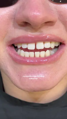 In this case I used composite edge bonding on 6 upper & 4 lower teeth to close the gaps whilst maintaining a very natural appearance as per the patients request 🤍
