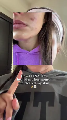 The best supplement to heal hormones!! #hormones #hormoneimbalance #acne #skin #skincare 