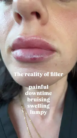 Beauty is pain✨💉💘 #lipfiller #filler #restylanekysse #nurselife #nursesoftiktok 