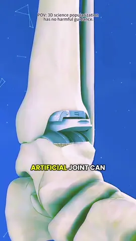 Total Ankle Replacement Surgery (3D Animation) #anklereplacement #anklereplacementsurgery #anklesurgery #totalankleteplacement #totalanklearthroplasty #anklejoint #anklejointsurgery #anklearthritis #medical3danimation #3dmedicalanimation