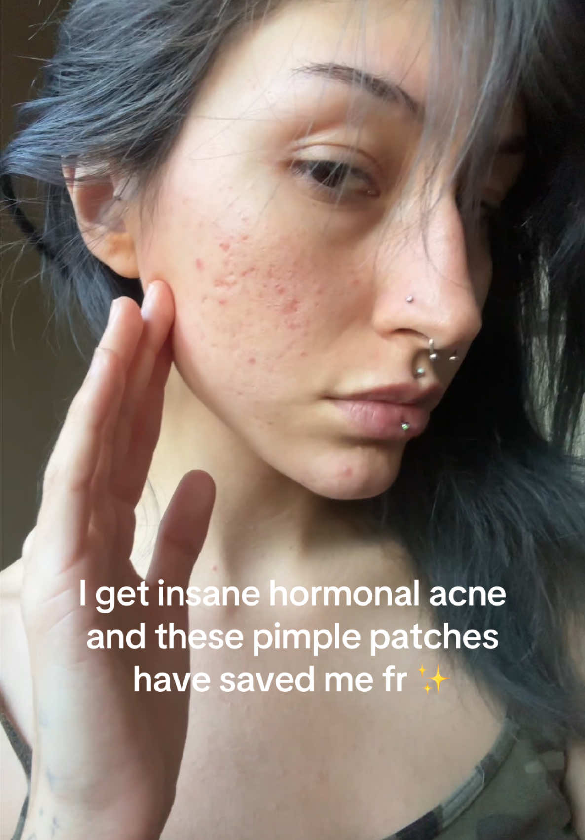 I genuinely am obsessed with these pimple patches, I love how many it comes with !! I’m gonna need to order more soon !! #romepie #viral #fypシ #aesthetic #acne #pimplepatch #trending 