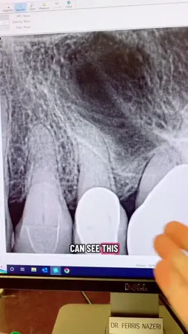 So calcified. RCT done through a crown. #dentists #rootcanal #dentistry #dentalstudent #dentalhygienist 