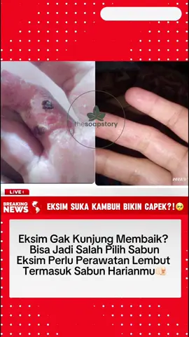 Eksim ga kunjung membaik?!🥹 pejuang eksim kumpul 🫵🏻 #eksim #sabunviral #sabunhandmade #sabunnatural #thesoapstory @THE SOAP STORY @THESOAPSTORY 