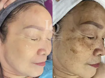 Cập Nhật Da Nám #chamsocdamun#chamsocdanam #chamsocseo#lequynhspa#hocnghespa