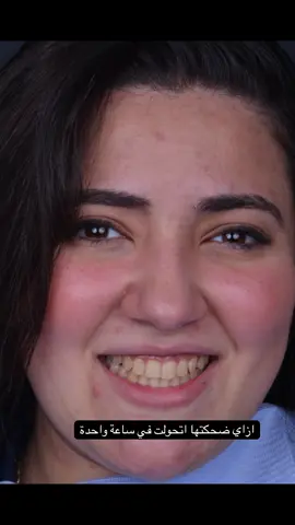 لو اسنانك جميلة بس لونها مش عاجبك في ساعة واحدة بس نقدر نغير ابتسامتك مستني ايه اتواصل معانا علي 01006366178 او اكتبلنا ابتسامة في الكومنتات 
