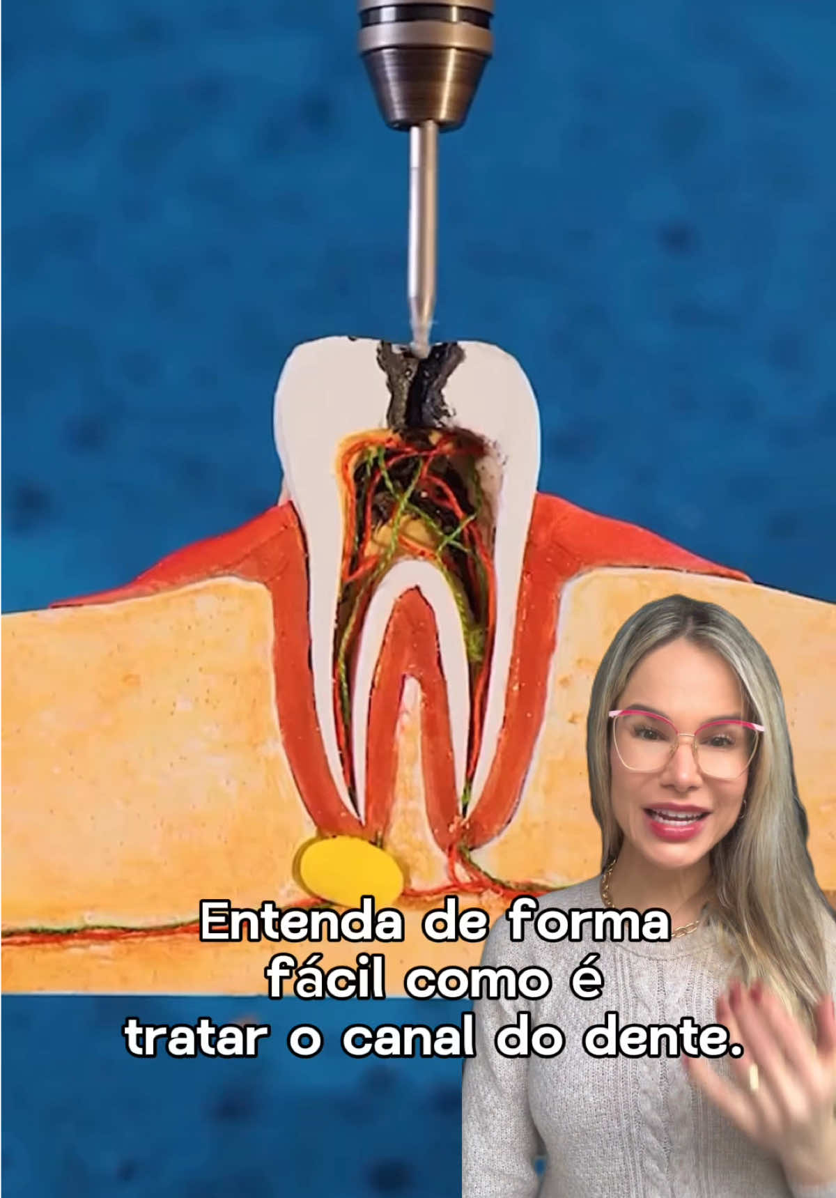 Entenda de forma fácil como é tratar o canal de um dente 🦷 #tratamentodecanal #dordedente #saude #passoapasso #odontologia 