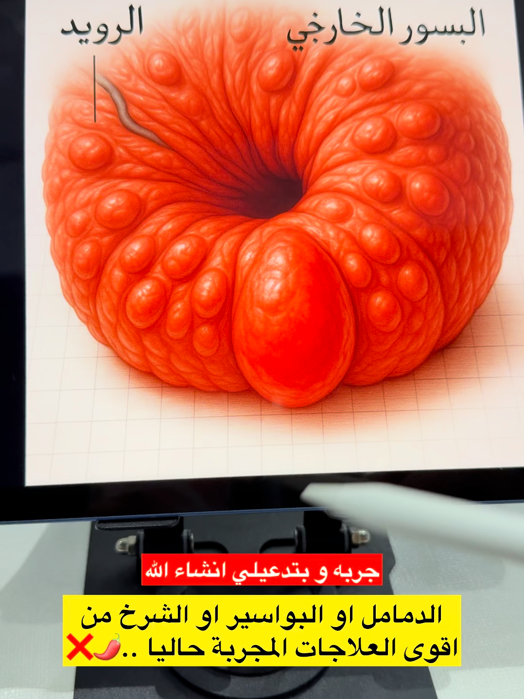 #بواسير_خارجية #healthy #بواسير_داخلية #الناسور_الشرجي #الناسور_العصعصي #الناسور #اكسبلور #صحة_عامة #الشعب_الصيني_ماله_حل😂😂 #اكسبلورexplore❥🕊 #مرض #ارشيف #شرح #بواسير #fyp #نصائح #اكزيما_الجلد_عن_الكبار_والصغار #اكزيما #life