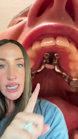 Adult palate expansion update. It’s almost been four months since I had my palate expander installed. This difference is crazy. Let me know what questions you have! #MARPE #palateexpander #orthodontics #fypシ #beforeandafter 