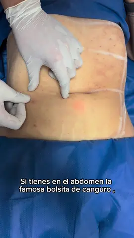 Es común que en el abdomen bajo se acumule la famosa “bolsita de canguro” 🦘  ✨¿Quieres decirle adiós a la famosa bolsita de canguro?🦘  El Endolifting láser en abdomen bajo es la solución 🔥 💎 Beneficios: ✅ Disminuye la grasa localizada ✅ Elimina la flacidez ✅ Tensa la piel sin cirugía ✅ Recuperación rápida Olvídate de los complejos y luce un abdomen más firme y definido 💃🏻 📍 Agenda tu valoración hoy mismo y descubre cómo el Endolifting puede transformar tu abdomen. #endolift #laser #grasaabdominal #abdomen 