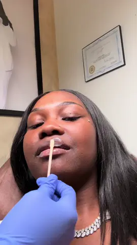 I’m Back With The Blogsssss Yall Want More ? Let Me Know ! I GOT MY LIPS FILLEDDDD 🥲🥲 @Jay Chanel #Lip #Lipfiller 