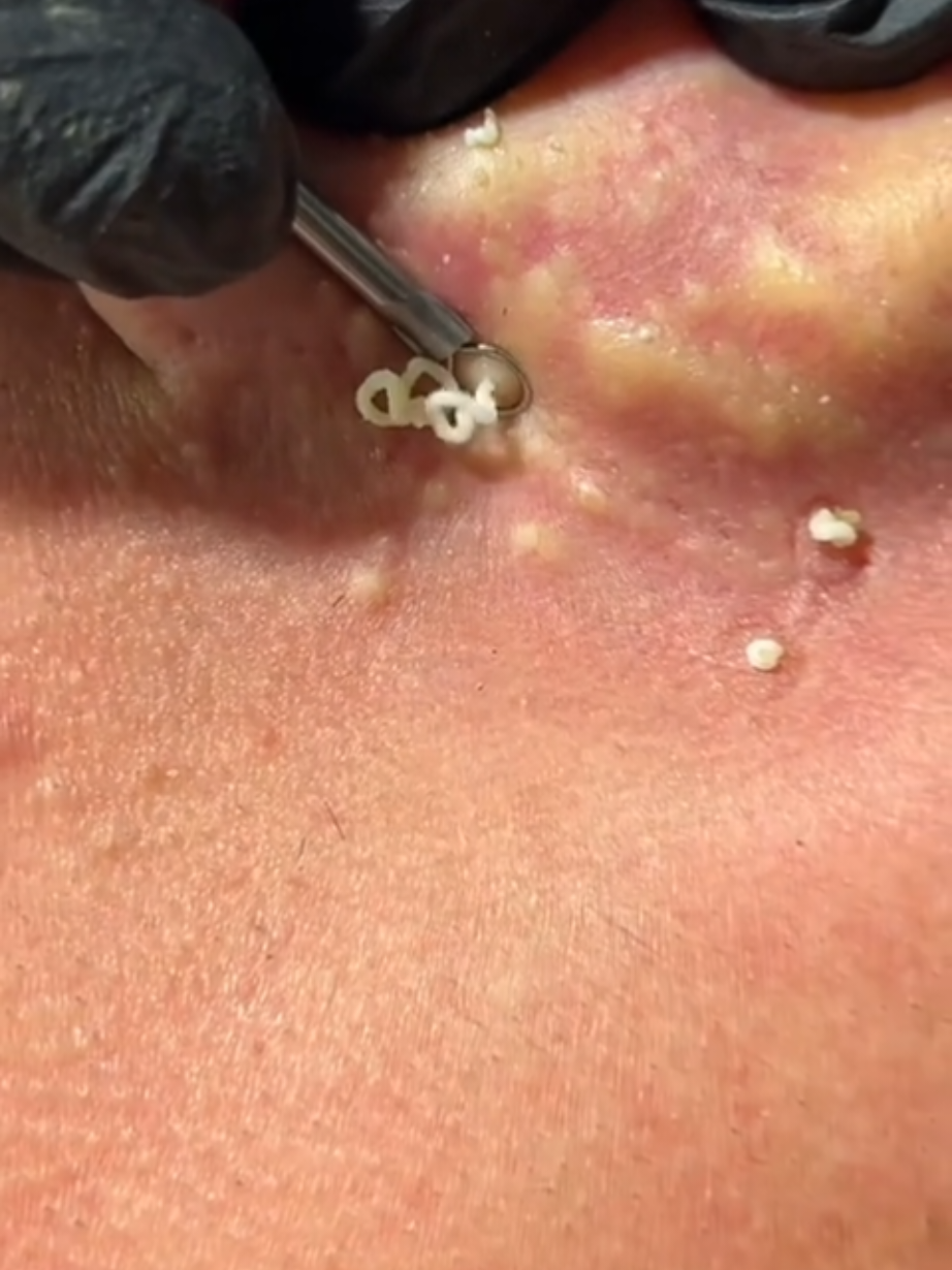 The best one today 🔥 Follow   #pimples #blackheads #viral #pimplepopping #oddlysatisfying 