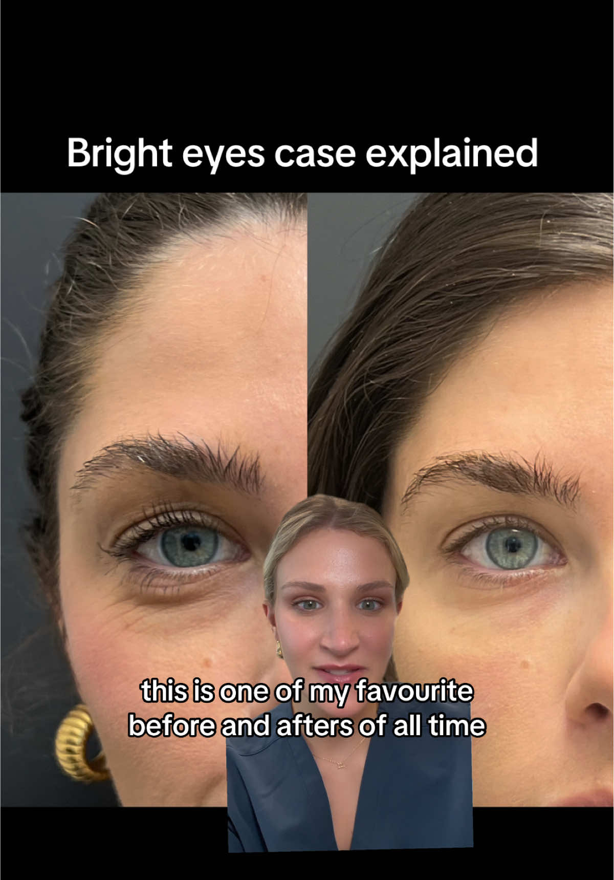 Exactly how I corrected undereye wrinkles, darkness, and hallowing in just 2 sessions!  #undereyebags #darkcircles #prf #eyecream 