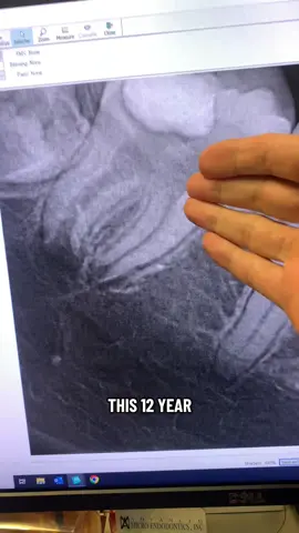 12-year-old needed a root canal. #dentists #rootcanal #dentistry #dentalstudent #dentalhygienist 