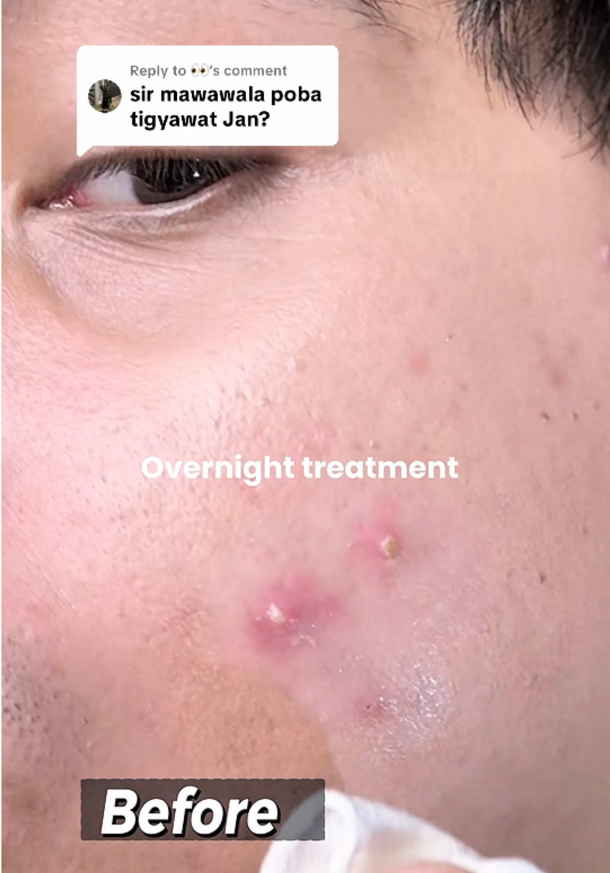 Replying to @👀  OVERNIGHT TREATMENT PARA MAG DRY AGAD ANG PIMPLES   USING BEAUTY VAULT REJUVENATING SET 