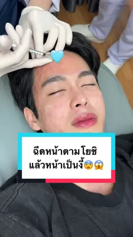 ฉีดหน้าตามโยชิ แล้วได้หน้าเป็นงี้ ใครรับได้บ้าง😱😨  #รีวิวคลินิก #รีวิวของดีบอกต่อ #fypシ #fyppppppppppppppppppppppp #fypシ゚ #รีวิวไปเรื่อย #รีวิวฉีดหน้า #รีวิวสกินแคร์ #โยชิ #โยชิมาทำไม #โยชิรินรดาธุระพันธ์ #yoshi #yoshirinrada #หน้าเนียน #หน้าใส #งานผิวดารา #เซตผิวโยชิ #หน้าใสไร้รอยสิว #หน้ากระจ่างใส #หน้าขาว #หน้าเนียนใส #หน้าเรียบเนียน #ฉีดหน้าใส 