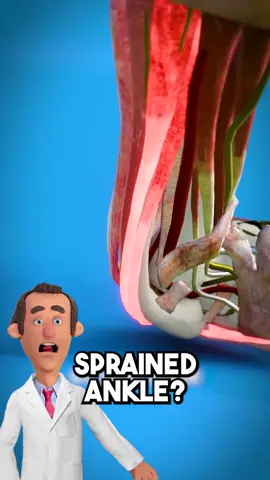 What is a sprained ankle? follow Dr. Pickle for MORE ‼️ #doctor #health