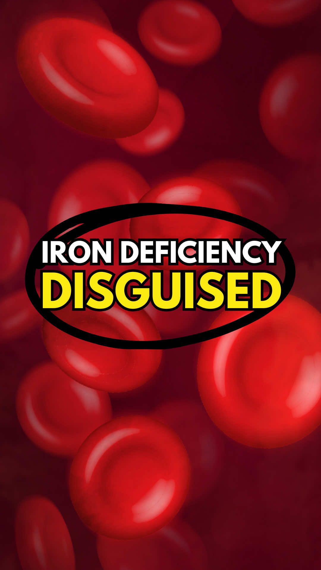 It’s easy to think that normal ferritin levels mean your iron status is fine. But ferritin only reflects stored iron, not what’s actually being used by the body. Iron can still be low if serum iron, binding capacity, or saturation are down, meaning it’s locked away and unusable. This often occurs when the body is dealing with inflammation, infections, gut issues, heavy metals, or even parasites. In these cases, the liver releases a signal called hepcidin, essentially “locking the bank” and preventing iron from being released so it doesn’t feed pathogens. On today’s Cabral Concept 3504, I break down why you may have low iron even when ferritin looks normal, how your body is protecting itself, and what this means for your health. Listen now at StephenCabral.com/3504 #wellnesstips #functionalmedicine #naturopath #lowiron 