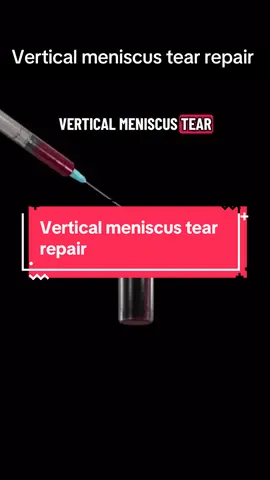 Vertical tear repair: stitch it, save it, strengthen it 🦵💥#meniscus #meniscusrepair #knee #LearnOnTikTok #physicaltherapy 