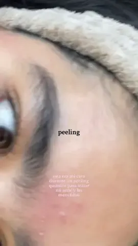 voy a tratar de documentar todo lo posible, porque la verdad me cuesta bastante ver así mi piel #acnetreatment #peelingskin #acneproneskin #acne #acnefighter 