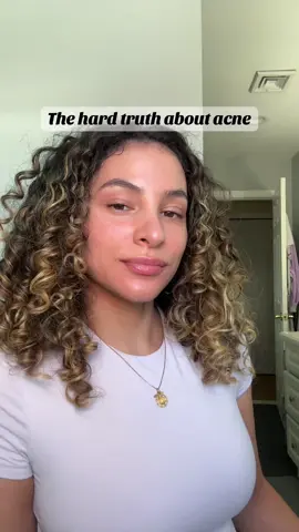 What are some things you do to keep your acne under control? #acne #adultacne #dermatology #tretinoin #foryou 