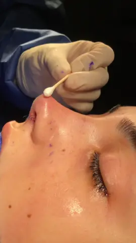 #rhinoplasty #beauty #plasticsurgery 