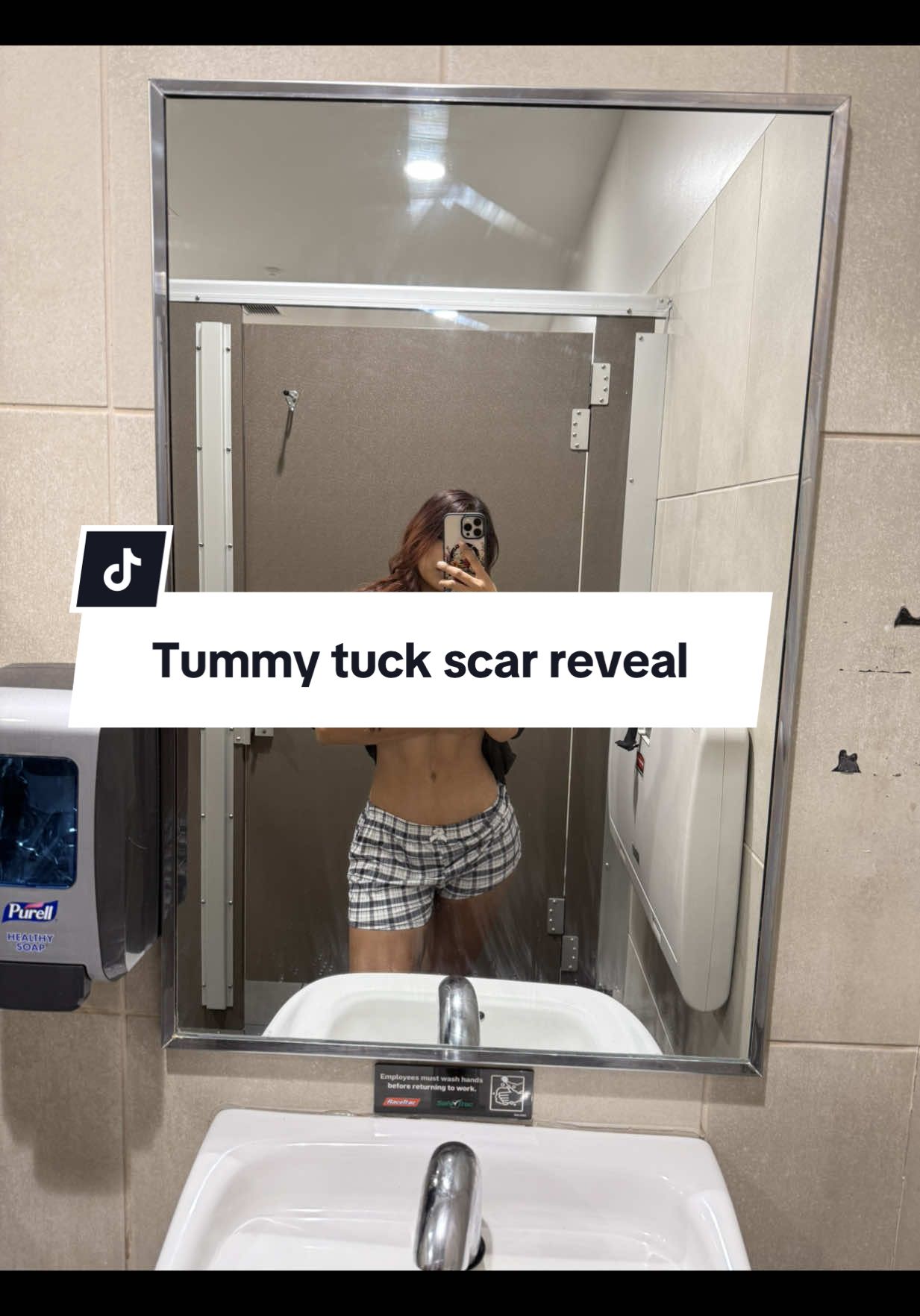 Replying to @N  #triggerwarnning #tuneada #cirujiasplasticas #plasticsurgery #tummytuck 