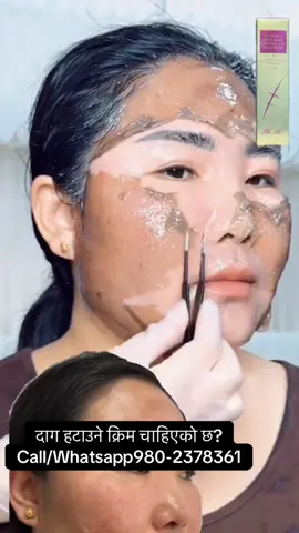 #foryou #scar #operation #viralvideo #stretchmarks 