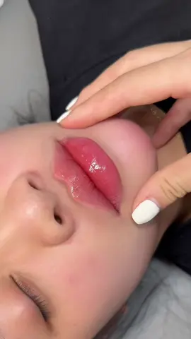 Môi sửa trên nền môi đã tiêm k rõ khuân dáng.#tiemmoi #moibaby #xuhuong #catmoi #trending 
