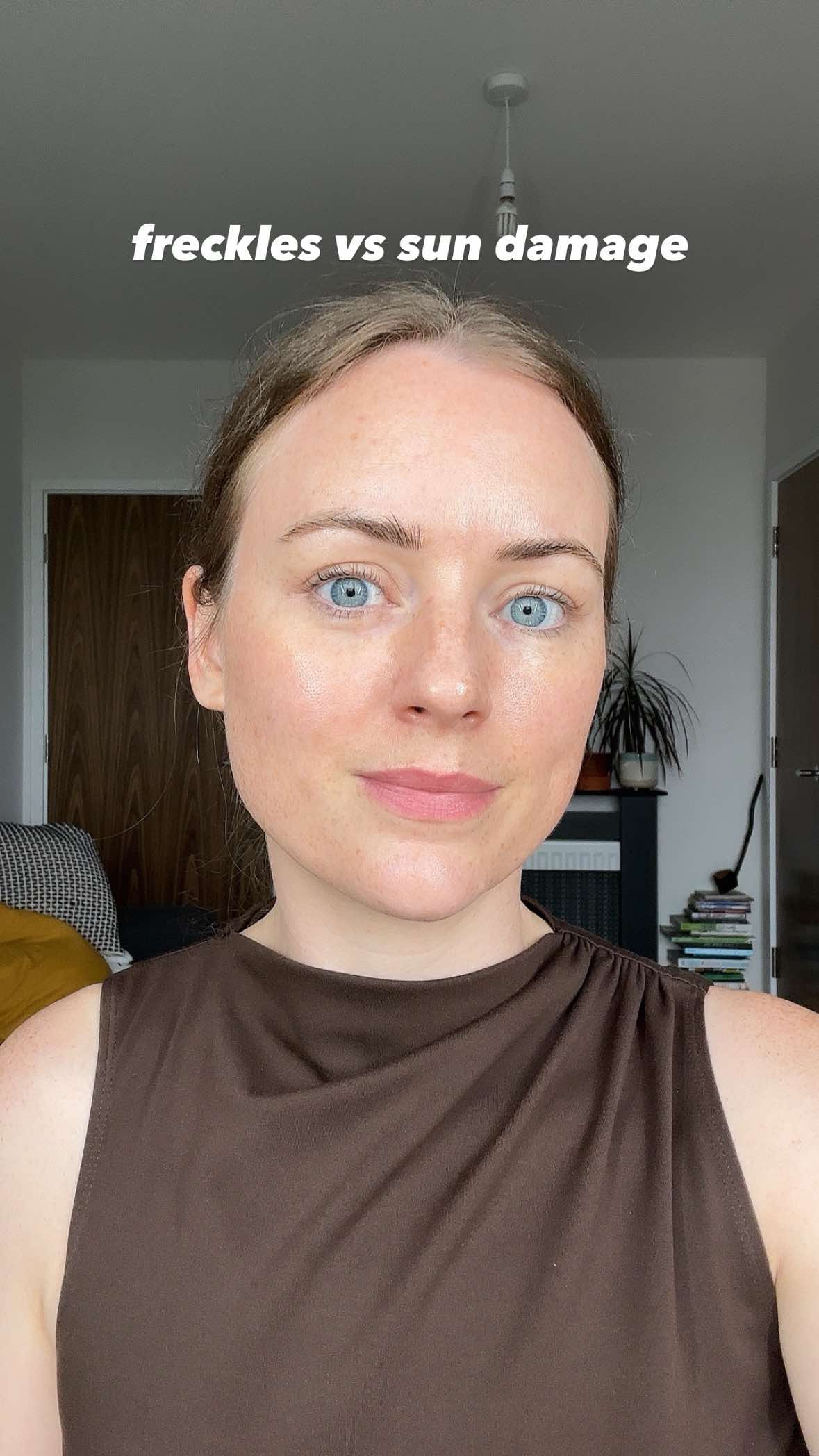 The ones on my forehead? Melasma babes, thanks 😅 #sundamage #sundamagedskin #freckles #melasma 