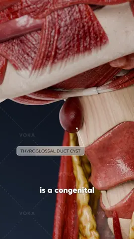 How can a thyroglossal duct cyst affect your health? 3D visualization A thyroglossal duct cyst is a benign and fluid-filled lump found in the anterior neck, near the hyoid bone. It forms during embryogenesis when the thyroglossal duct does not completely close, leaving behind a small fluid-filled structure. This cyst is usually painless but may grow larger over time.   While this condition is non-cancerous, it is not without risks. The cyst can become infected, causing discomfort, or in rare cases, undergo malignant transformation. Because of these potential complications, surgical removal is typically necessary to avoid further health issues.   📌 Learn more about fibroadenoma with VOKA 3D Anatomy & Pathology!   #thyroglossalductcyst #human #medicalstudent #3Danatomy #3Danimation           