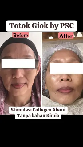 Kkrmcangkan Kulit dengan Totok Giok Appointment: “ KLINIK PSC Beauty&Health” • Cabang Jakarta  Jl. Malaka Iv No.3, Perumnas Klender, Duren Sawit, Jakarta Timur • Cabang Bekasi 📍RUKO GRAND WISATA AA11 No.72Jl. Celebration Boulevard, Grand WisataLambang Sari, Tambun selatan, Bekasi. Jawa Barat 17510 TELEPHONE/WA +62-85959402005 +62-81770644814 ig.@psc_beauty_health #totokgiok #akupuntur #akupunturwajah #facelift #totokwajah 