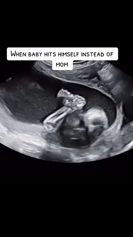 Baby KARMA 🫣 #pregnancy #baby #pregnant #ultrasound #ultrasoundtech 