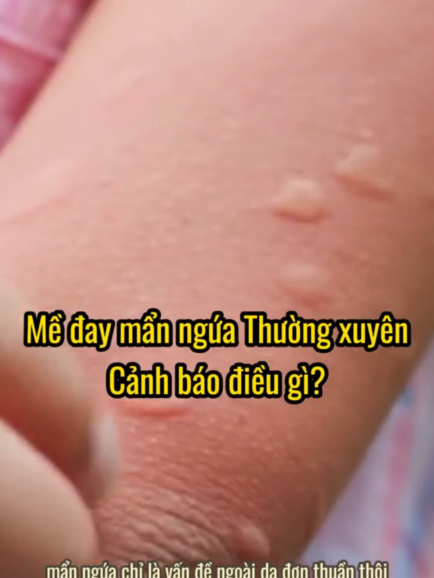 Mề đay mẩn ngứa thường xuyên cảnh báo điều gì? #phubikhang #meday #diung #manngua #giamngua #diungthoitiet