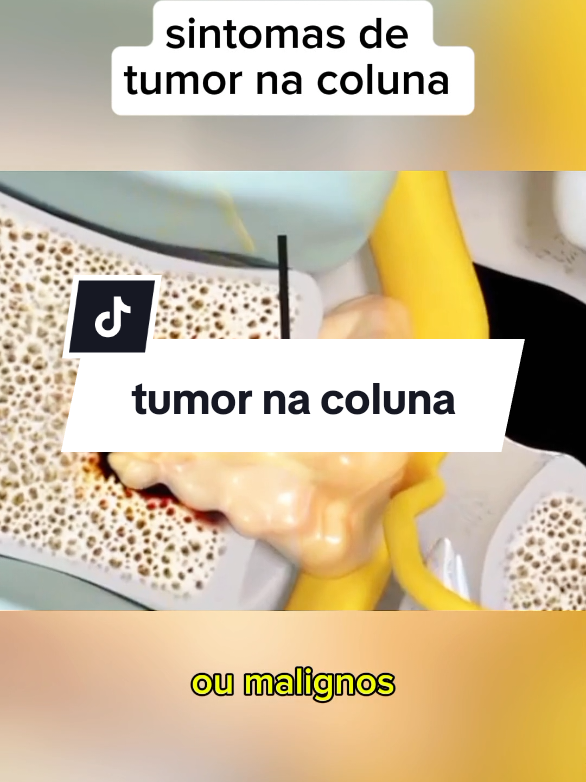 sintomas de tumor na coluna?#saude #coluna #tumornacoluna#tumor 