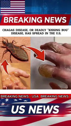 32 STATES HAVE REPORTED MULTIPLE CASES OF PARASITCIMFECTONS REOUIRING EMERCENCY TREATENT. #news #breakingnews #fyp #usa 