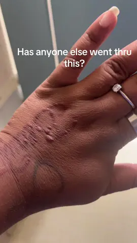 #bugbites #bites #tattoos #help #fyp