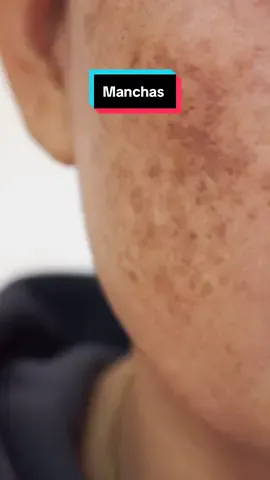🌟 ¡Dile adiós a las manchas con Azelac! 🌟 ¿Luchas contra las manchas en tu piel? Azelac es tu solución ideal gracias a su poderoso **ácido tranexámico**, que ayuda a reducir la hiperpigmentación y unificar tu tono. ✨ Beneficios Clave: - Disminuye visiblemente las manchas oscuras - Mejora la textura y luminosidad de la piel - Fórmula suave y efectiva para todo tipo de piel 💧 Resultados que se notan: Con el uso constante, ¡verás tu piel más radiante y uniforme! 🎉 Oferta Especial:¡ Consigue un [descuento o regalo] en tu primera compra! 👉 Desliza para descubrir cómo Azelac transforma la piel de nuestros usuarios. #Azelac #ÁcidoTranexámico #CuidadoDeLaPiel #Manchas #PielRadiante 