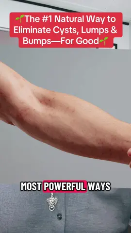 🌱The #1 Natural Way to Eliminate Cysts, Lumps & Bumps—For Good🌱#swelling #cysts 