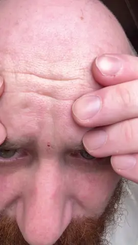This peel shot works almost too well #drmelaxin #peelshot #exfoliation 
