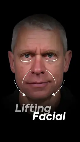 💎 Resultados que transforman Después de 3 meses del lifting deep plane, él luce un rostro más definido, natural y rejuvenecido. Una técnica que trabaja en profundidad para devolver firmeza y frescura sin alterar su esencia. 📍 Elebelle – Donde la experiencia y la tecnología logran cambios reales. #rejuvenecimientofacial #deepplanefacelift #belleza #Tacna #estetica