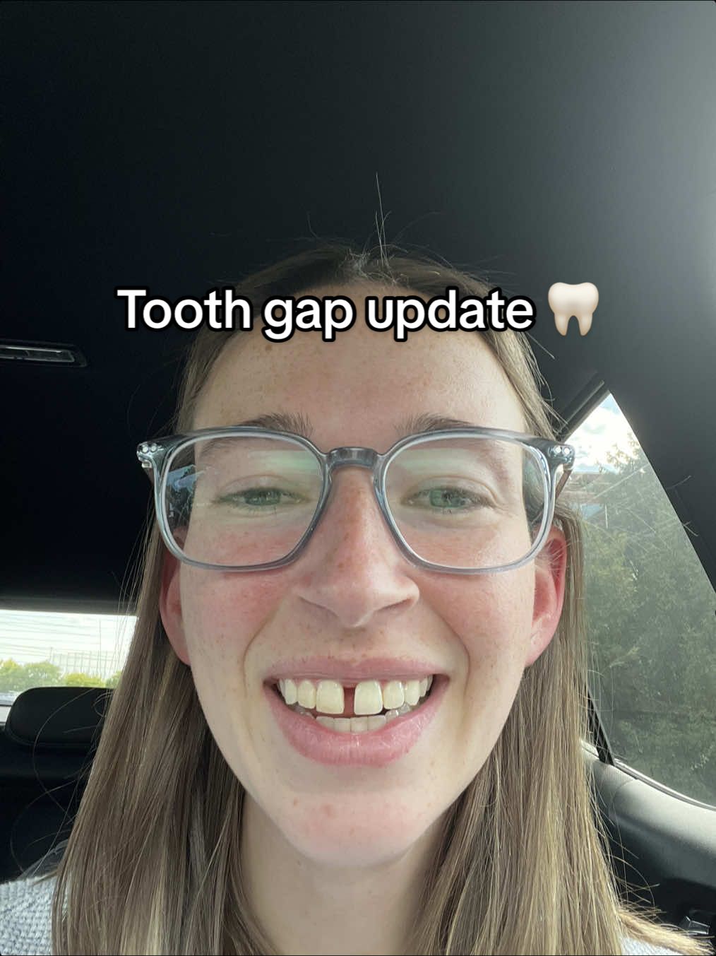 Teeth! Yay! Tooth gap! How fun. My teeth starting hurting like 3 days ago and the gap doesn’t seem to be growing a ton. But the necklace still fits. Braces go on on Monday #tmj #braces #marpe #jawsurgery 