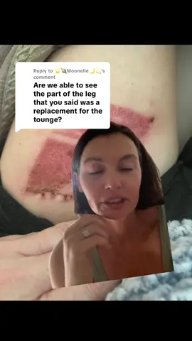 Replying to @🌟🪐Moonelle🌙💫 #greenscreen  after having half my tongue removed they patched it with my good ol’ left thigh. #tonguecancer #cancersurvivor 